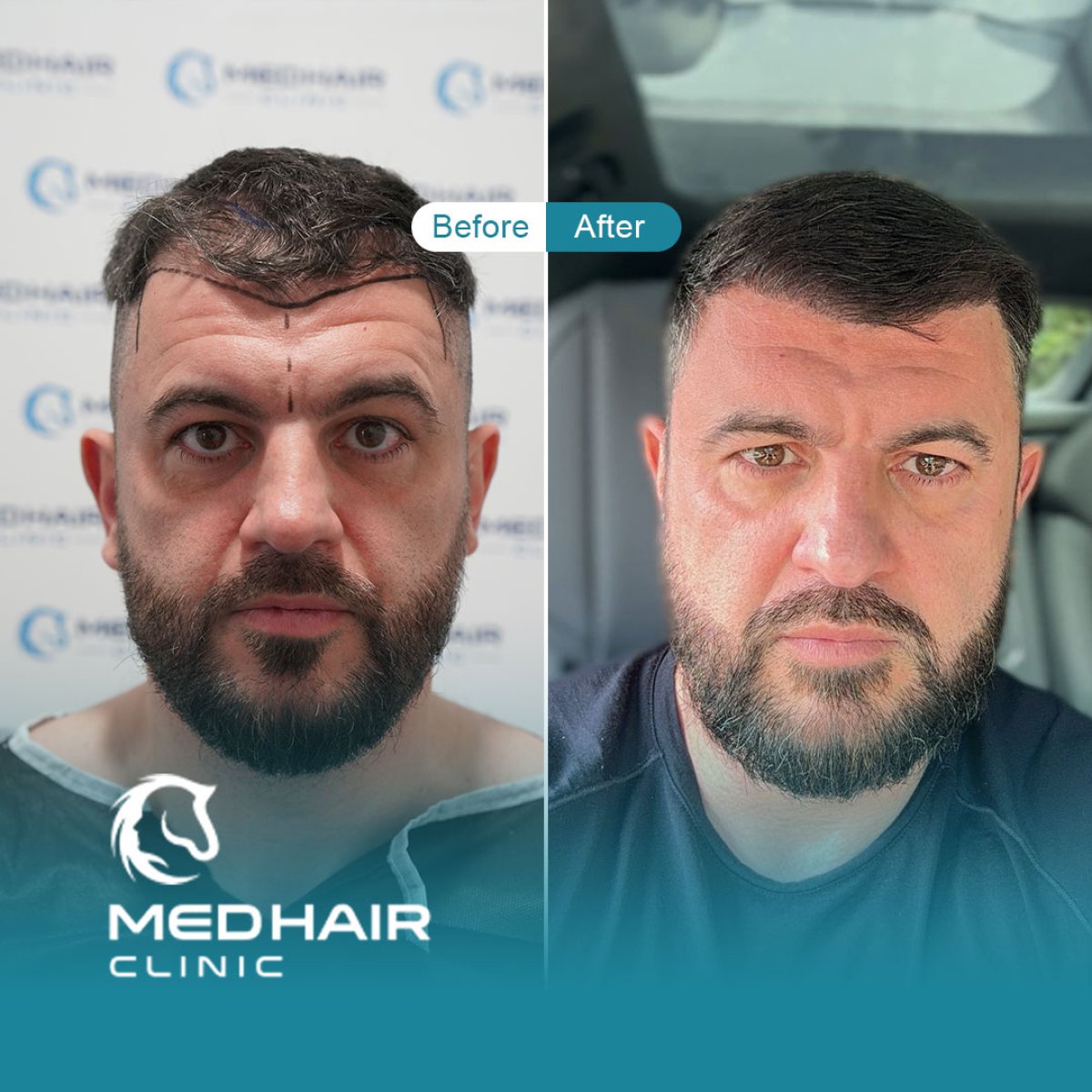 Before and after FUE hair transplant results at MedHair Clinic, improved hairline and density