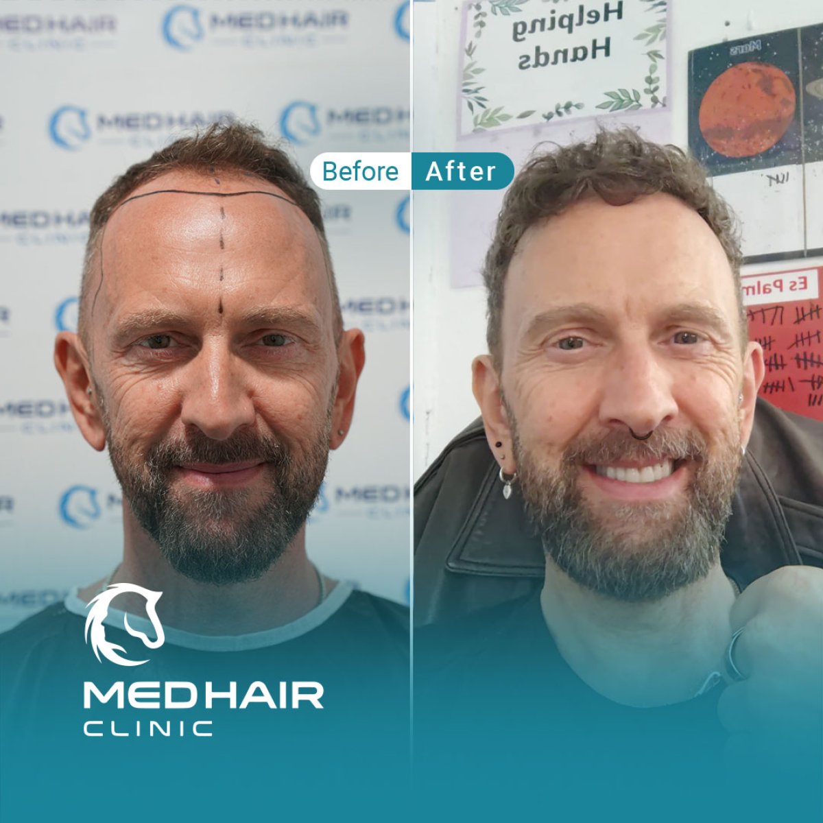 نتائج زراعة الشعر FUE قبل وبعد في MedHair Clinic، خط شعر محسّن للمريض