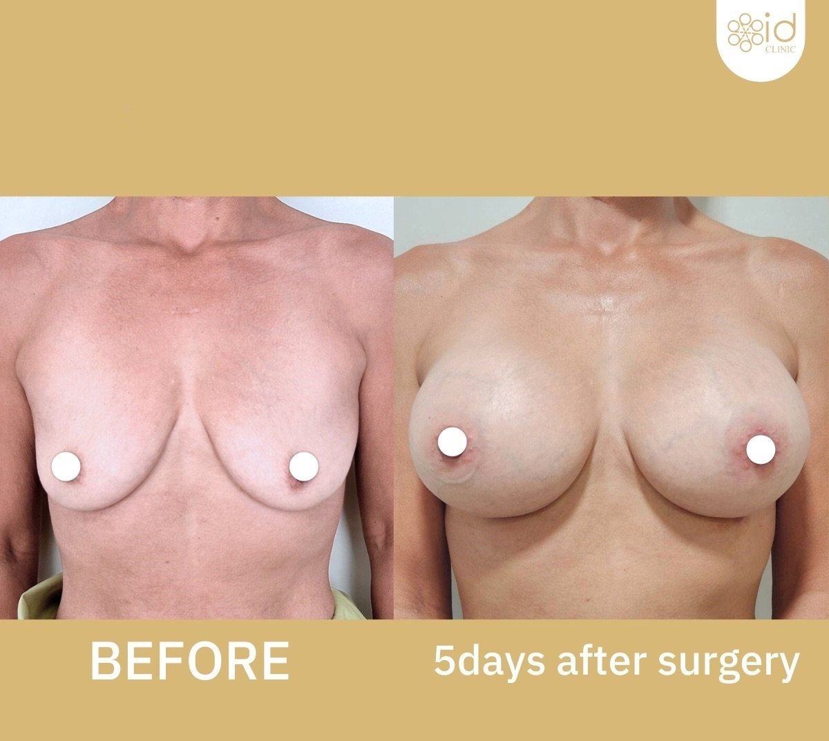 Before and after breast augmentation at ID Clinic Bangkok, visible enhancement results