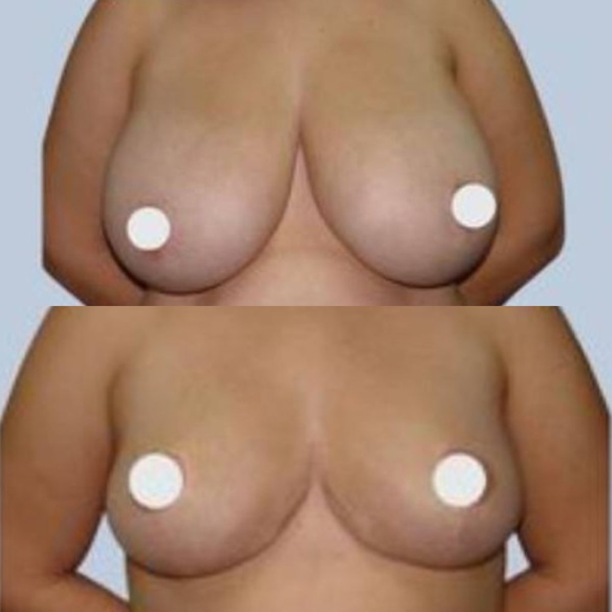 Before and after breast lift results at ID Clinic Bangkok – improved breast shape and lift
