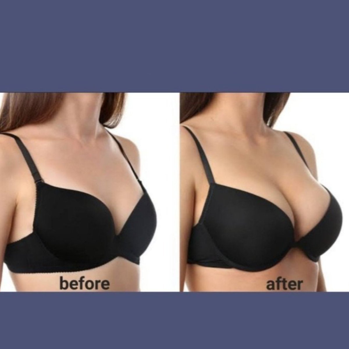 Before and after breast augmentation results at ID Clinic Bangkok, enhanced breast volume