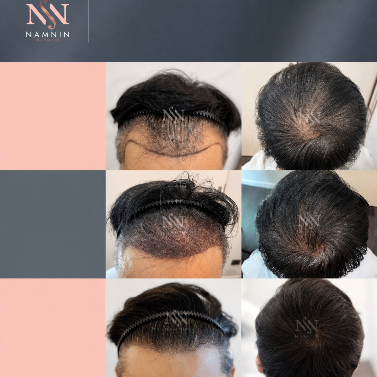 Before and after FUE hair transplant results at Namninforv Clinic, improved hair density