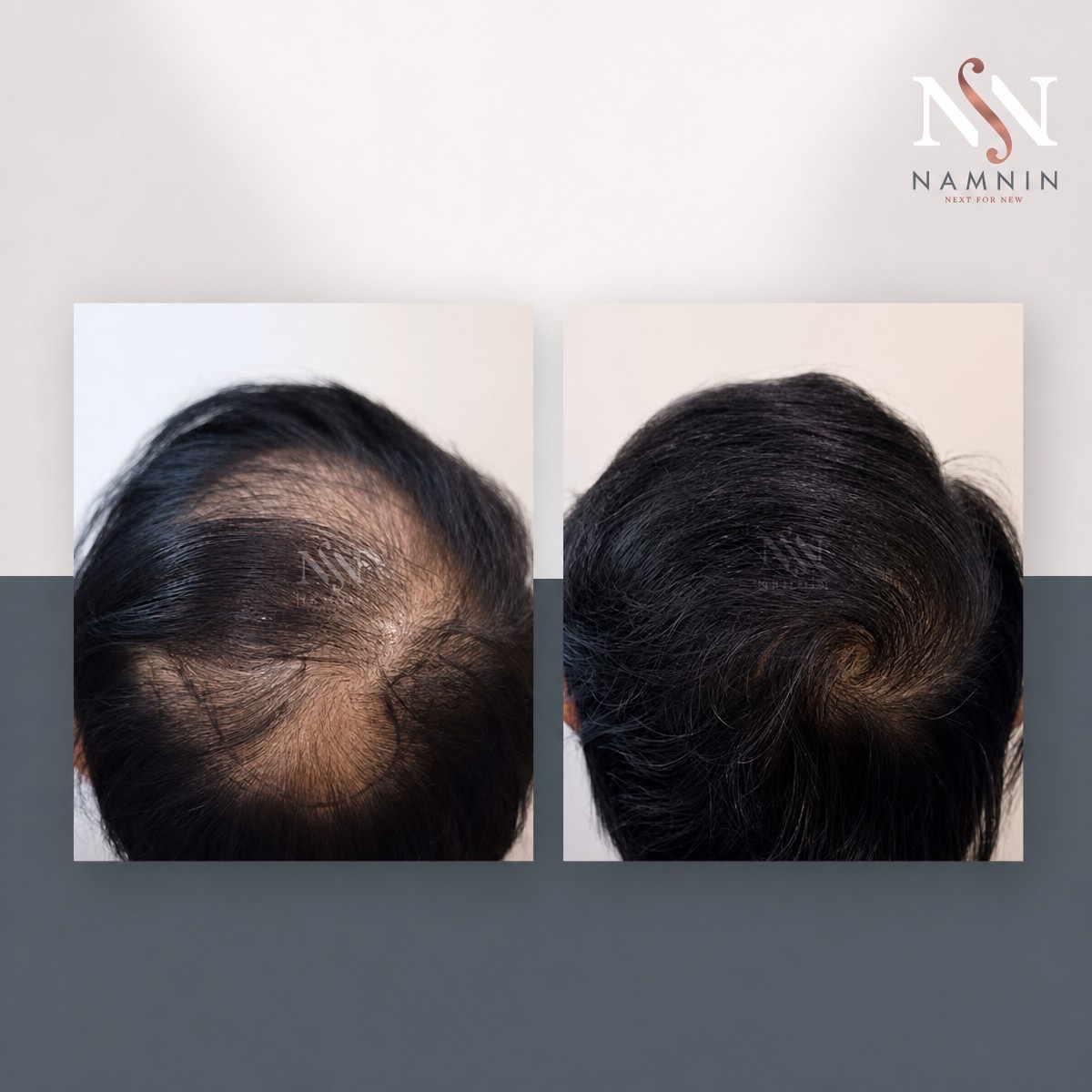 Before and after FUE hair transplant results at Namninforv Clinic, improved hair density