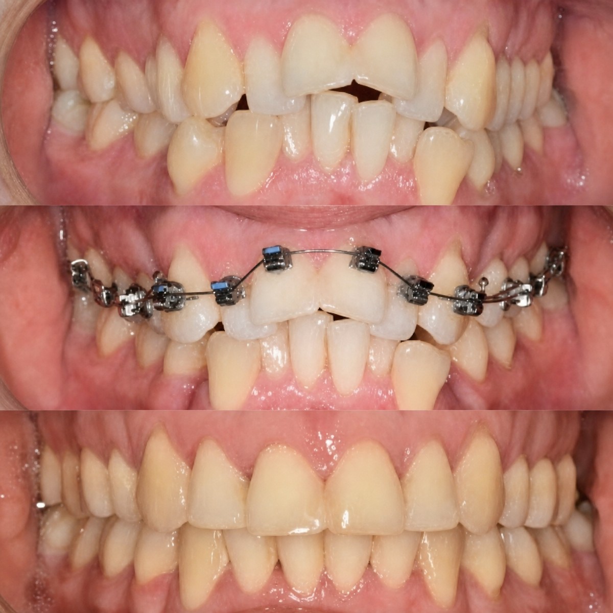 Résultats avant et après appareil dentaire chez Smile Centrum, alignement et correction de la morsure