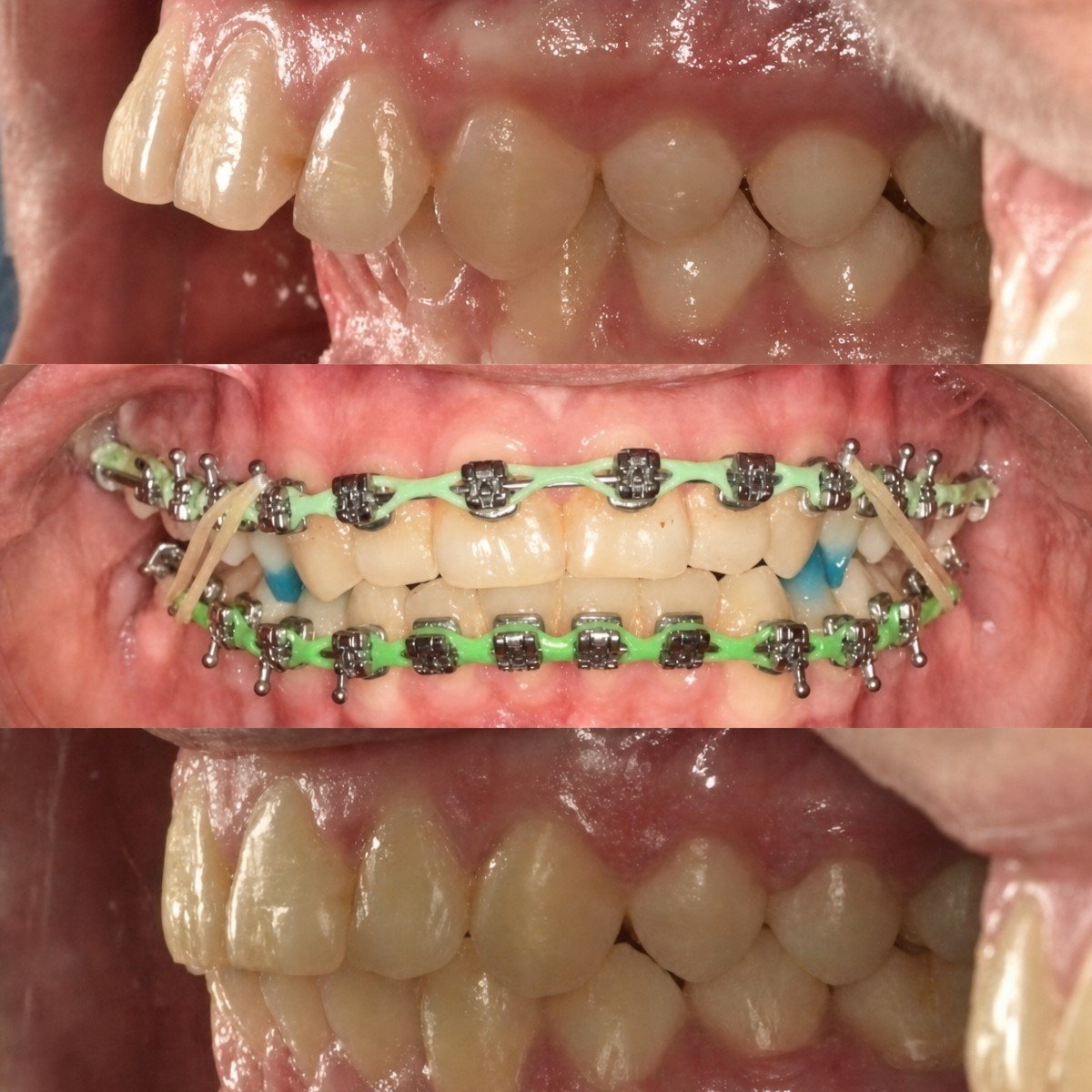 Résultats avant et après appareil dentaire chez Smile Centrum – alignement et correction de la morsure