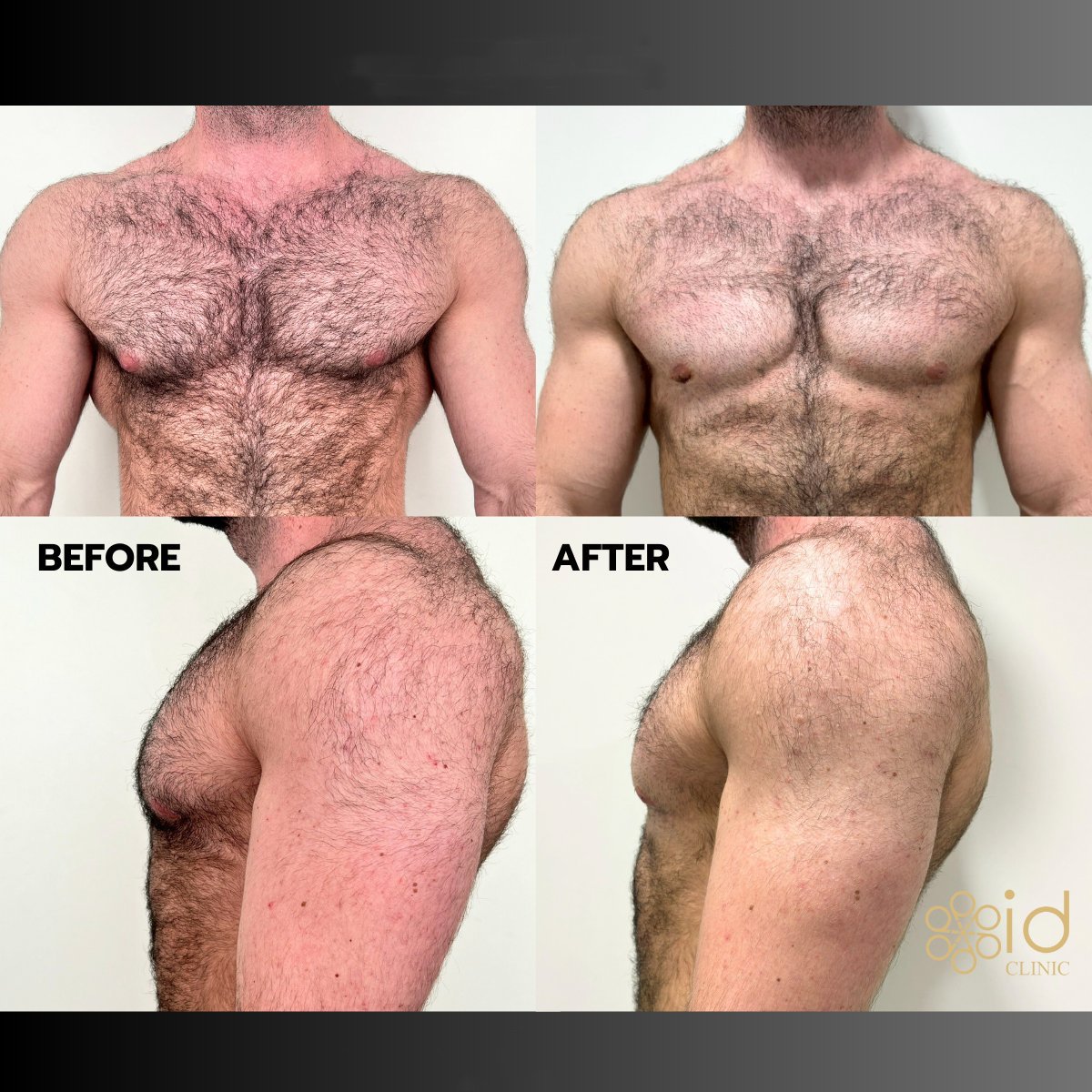 Resultados antes y después de liposucción Vaser para ginecomastia en ID Clinic Bangkok, contorno de pecho