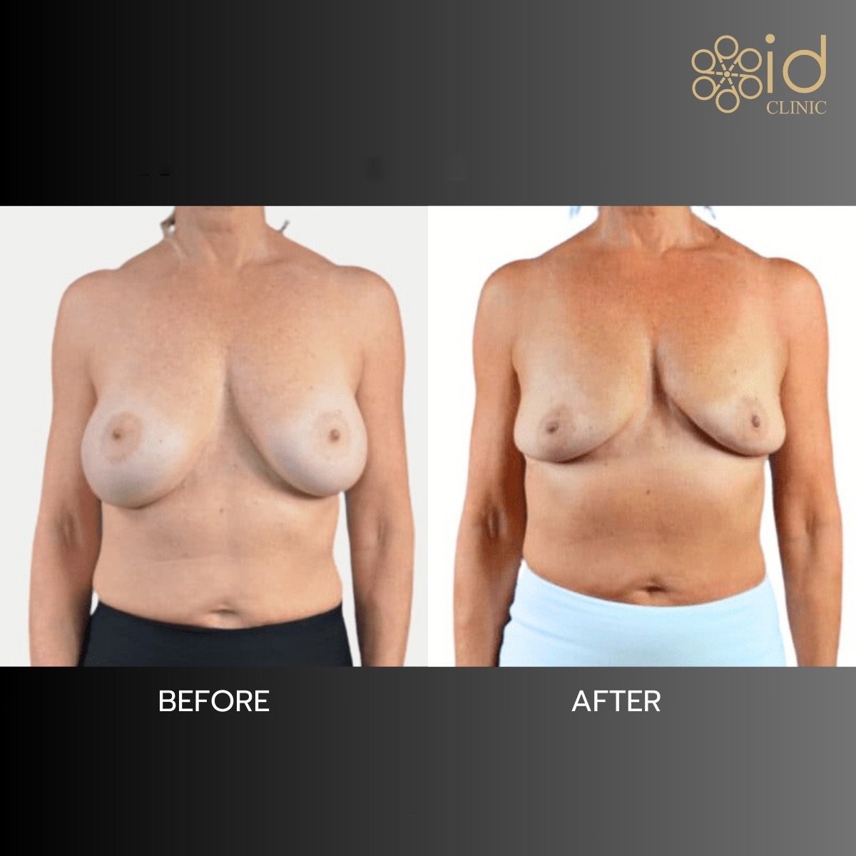 Before and after breast implant removal results at ID Clinic Bangkok, natural breast contour