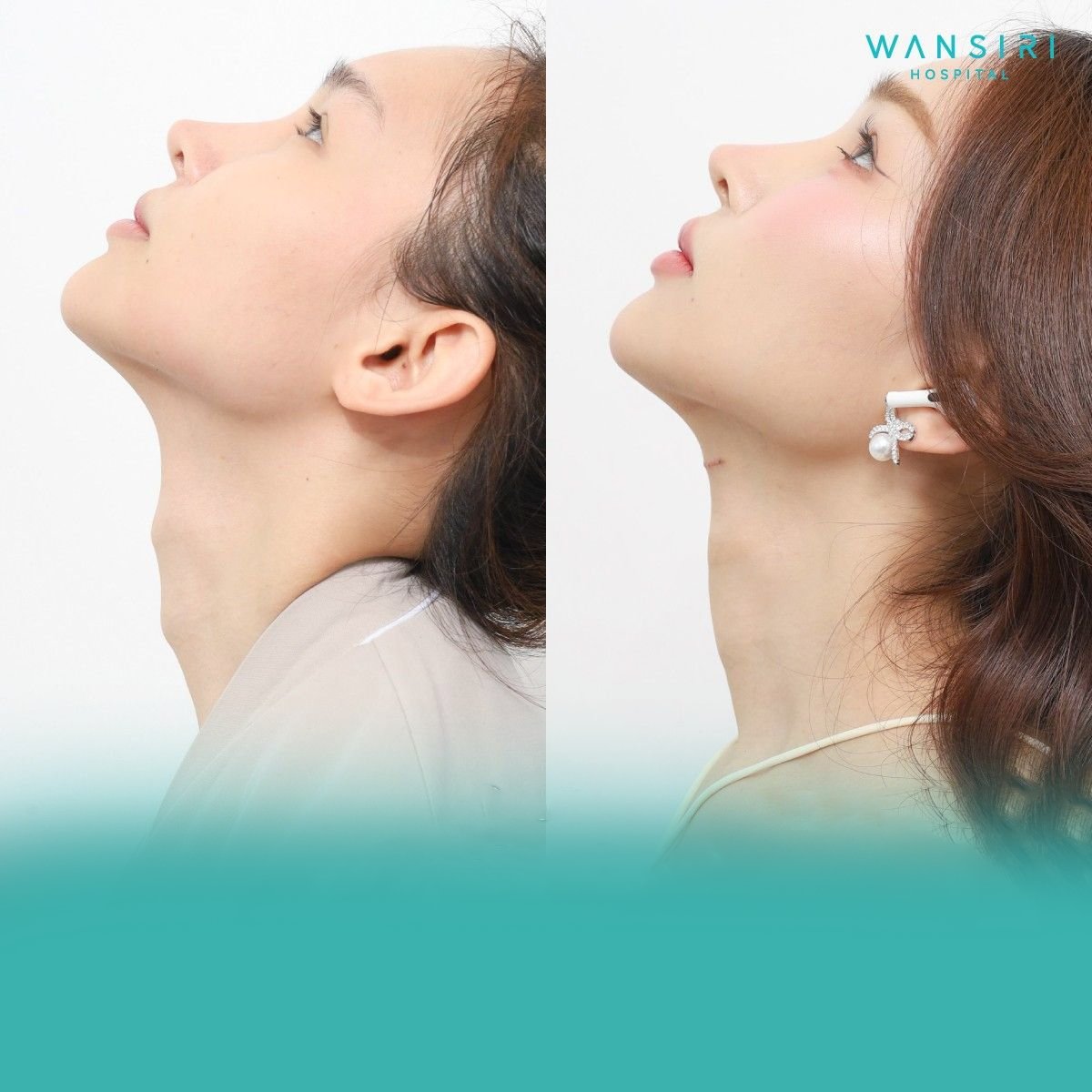 Before and after tracheal shave results at Wansiri Hospital – smoother neck contour visible