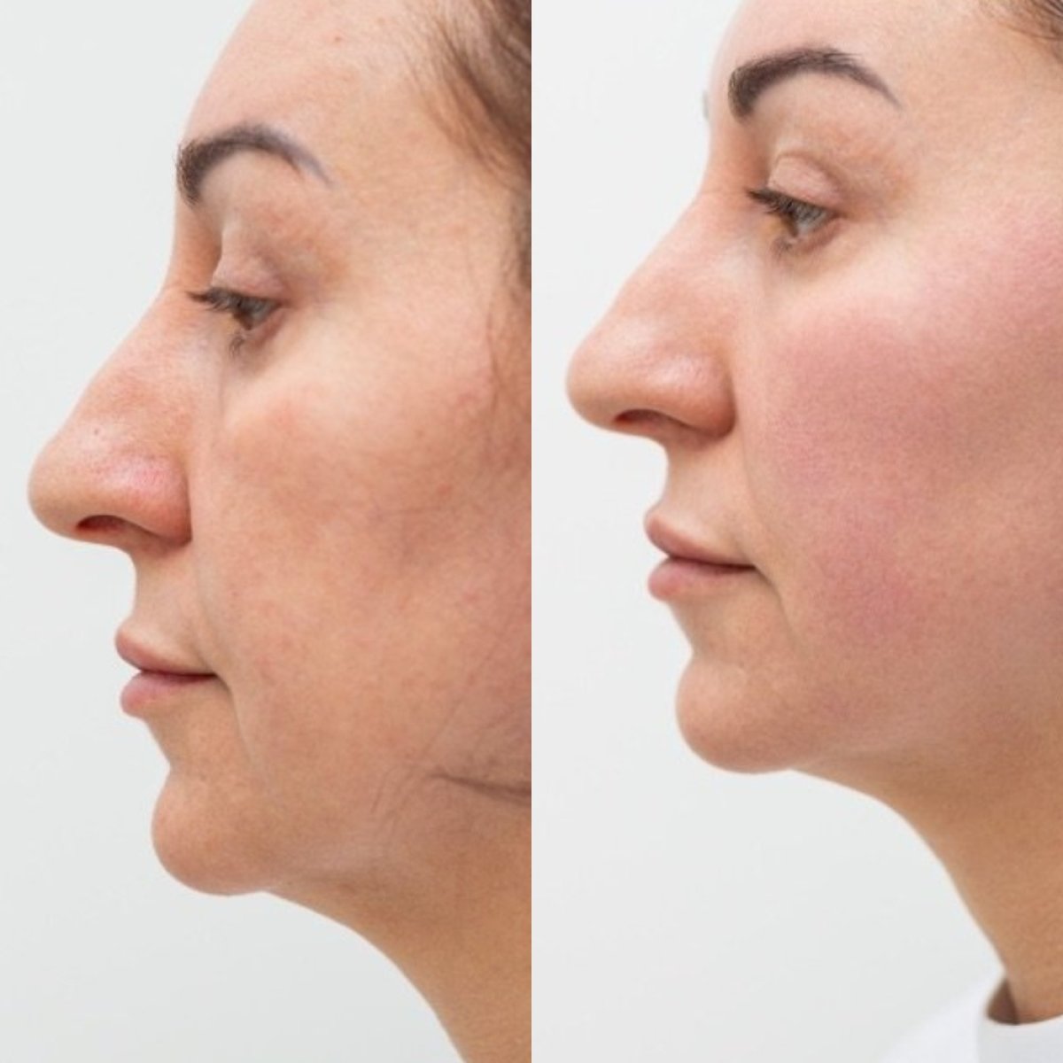 Resultados de lifting facial antes y después en Altos Clinic – contorno y piel más firme