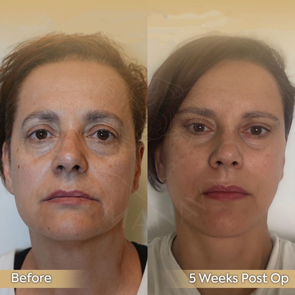 Before and after neck lift results at Dr. Safa Manav Clinic, visible neck and jawline improvement