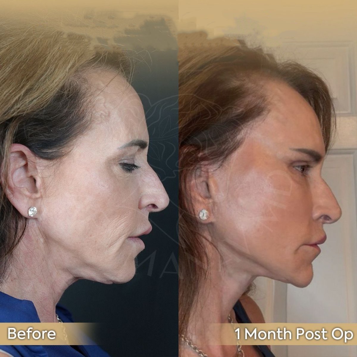 Resultados de lifting de cuello antes y después en Dr. Safa Manav Clinic, contorno visible