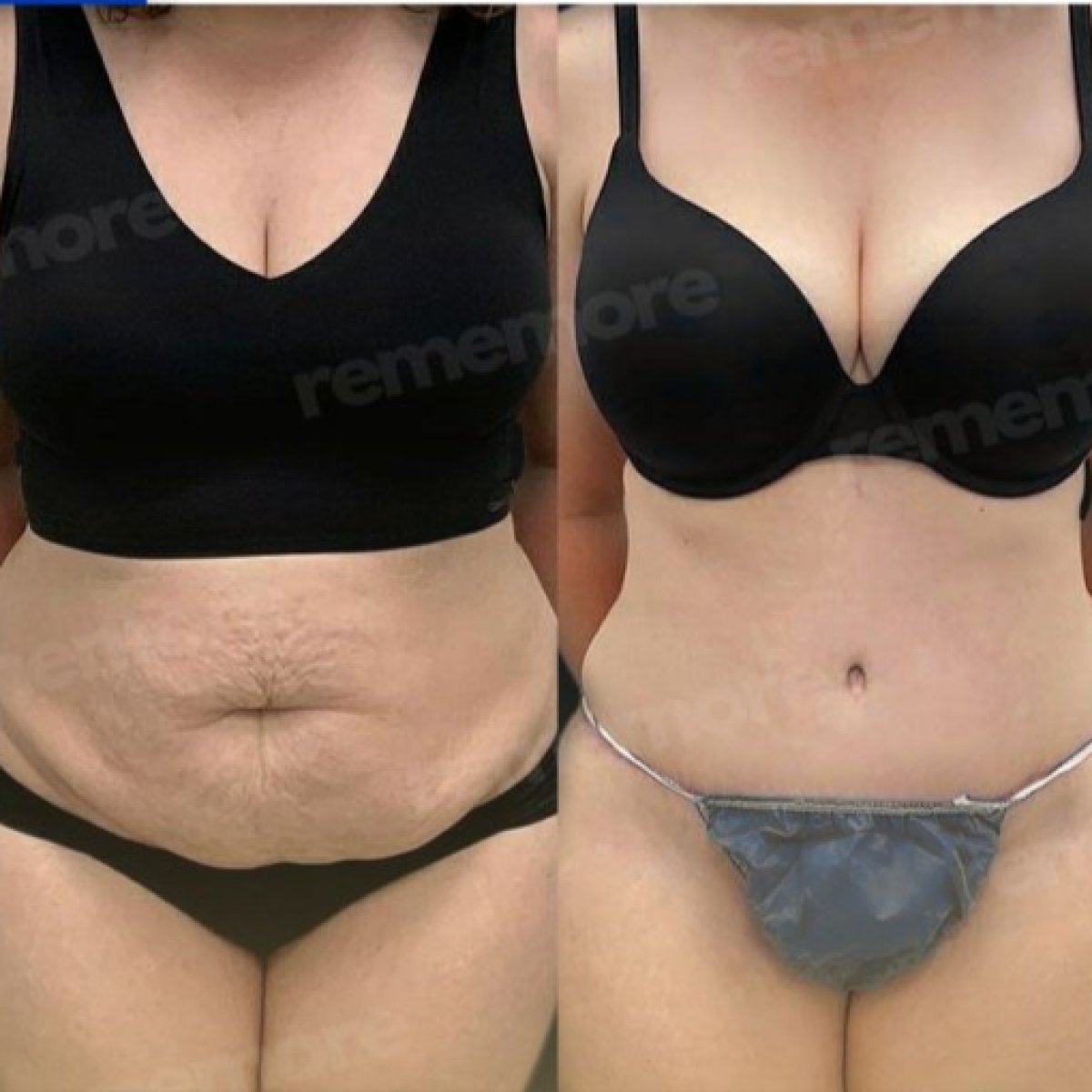 Resultados de abdominoplastia antes y después en Memorial Şişli Hospital, abdomen definido