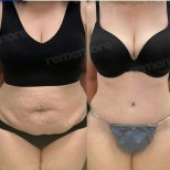 Before and after Tummy tuck photos by Dr. 