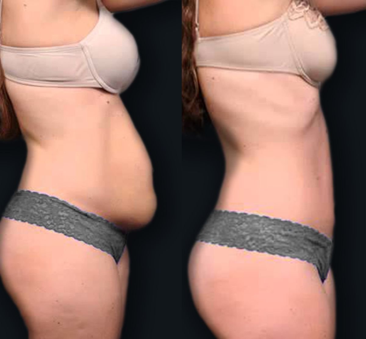 Before and after tummy tuck results at Memorial Şişli Hospital, visible abdominal contouring