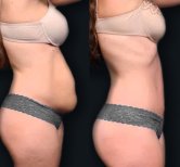 Before and after Tummy tuck photos by Dr. 