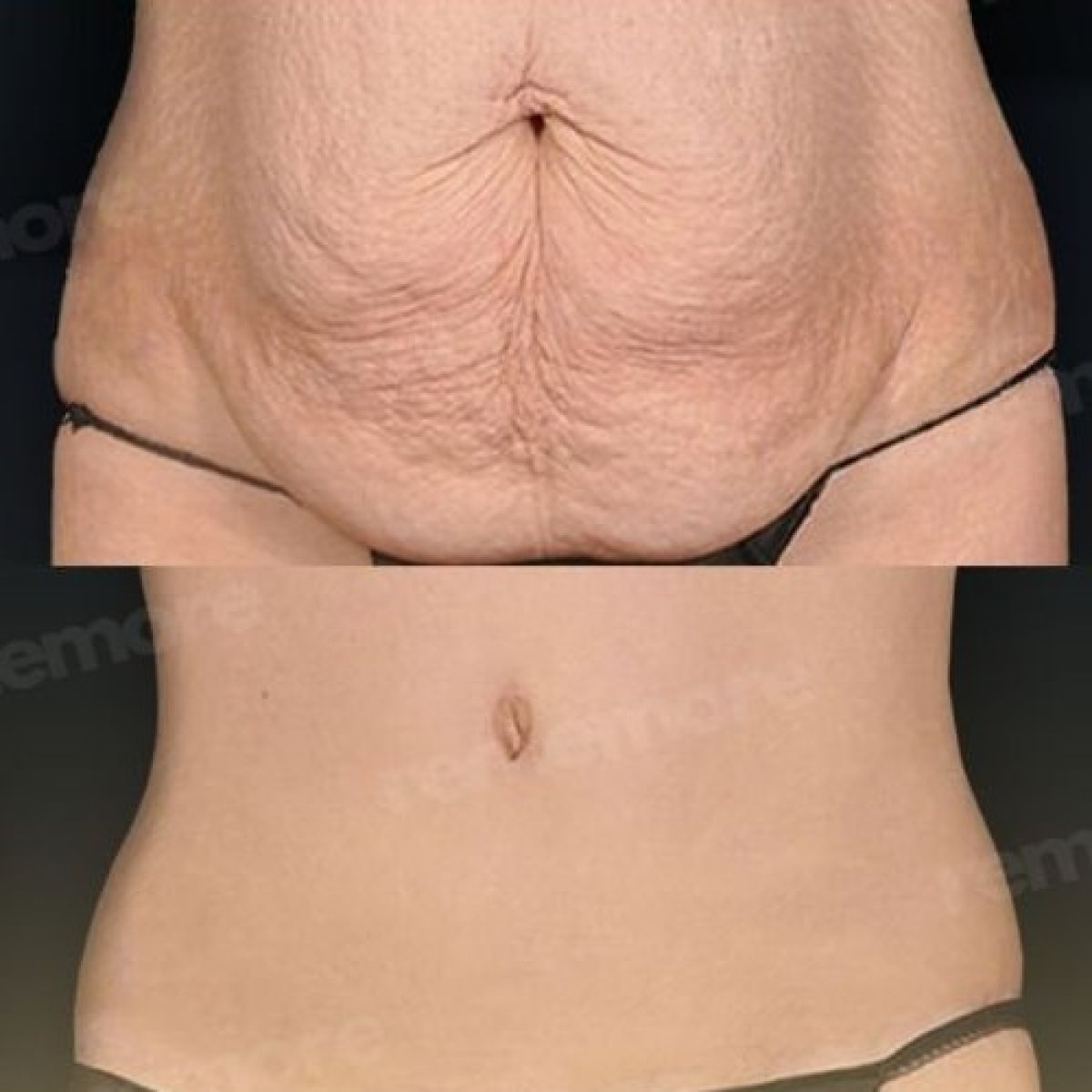 Before and after tummy tuck results at Memorial Şişli Hospital, improved abdominal contour