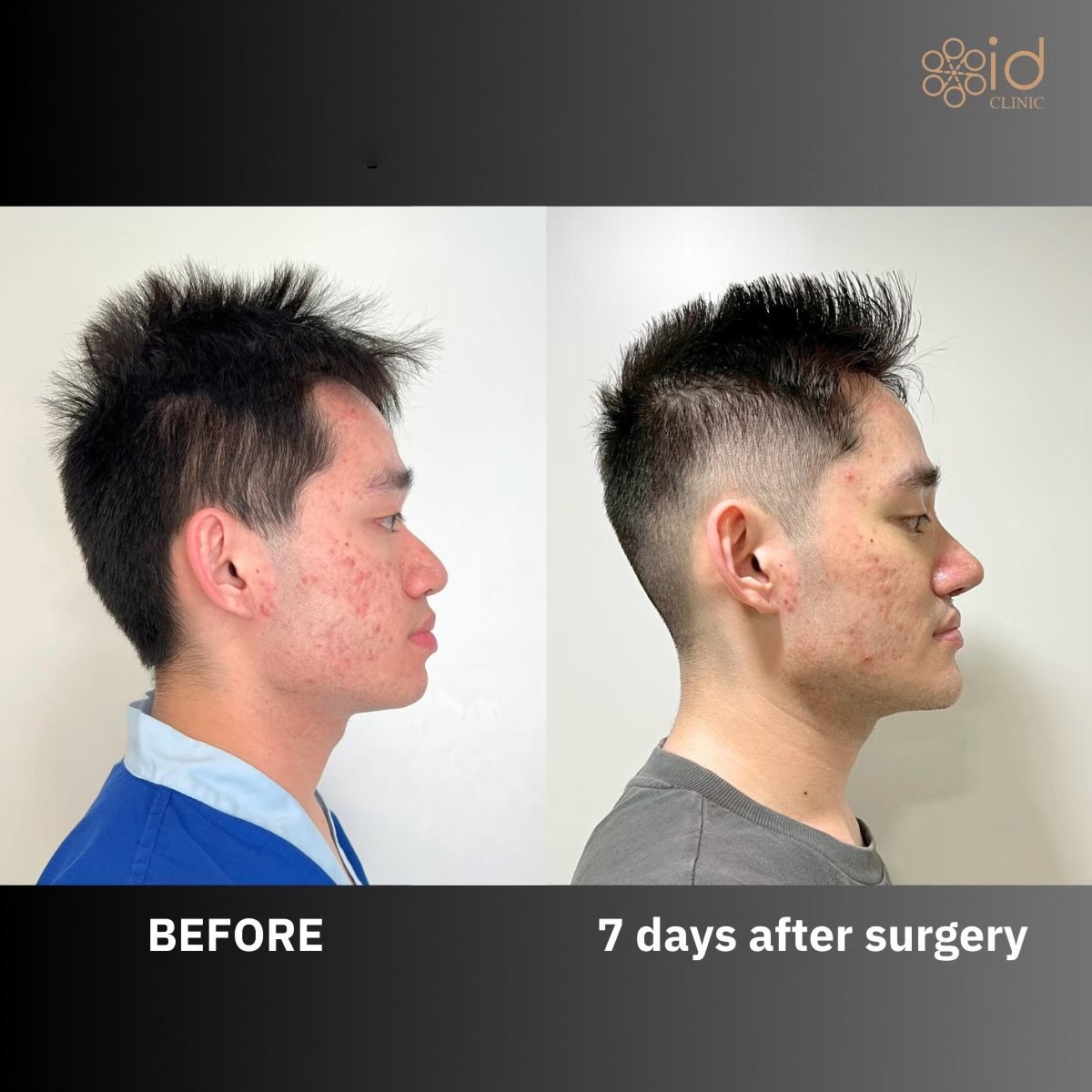 Before and after rhinoplasty result at ID Clinic Bangkok, improved nose profile after 7 days