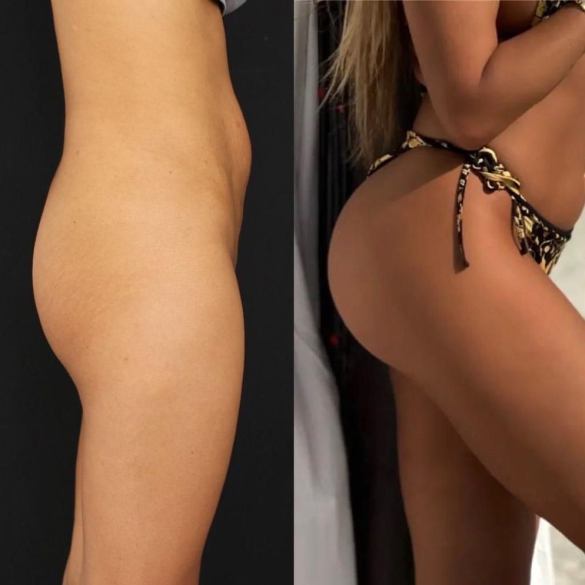 Antes y después de implantes de glúteos en Dr. Safa Manav Clinic, curvas y volumen mejorados