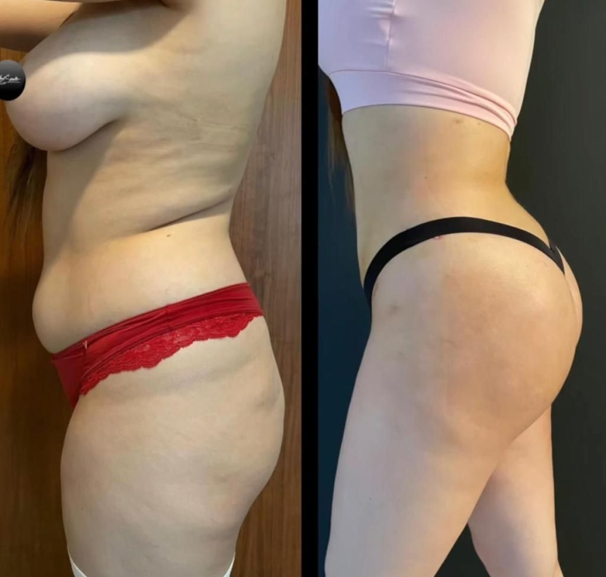 Antes y después de implantes de glúteos en Dr. Safa Manav Clinic, curvas mejoradas