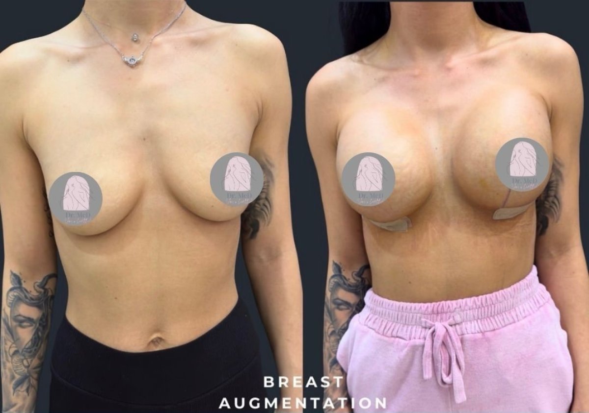 Before and after breast lift with round implants at Dr. MED – visible augmentation results