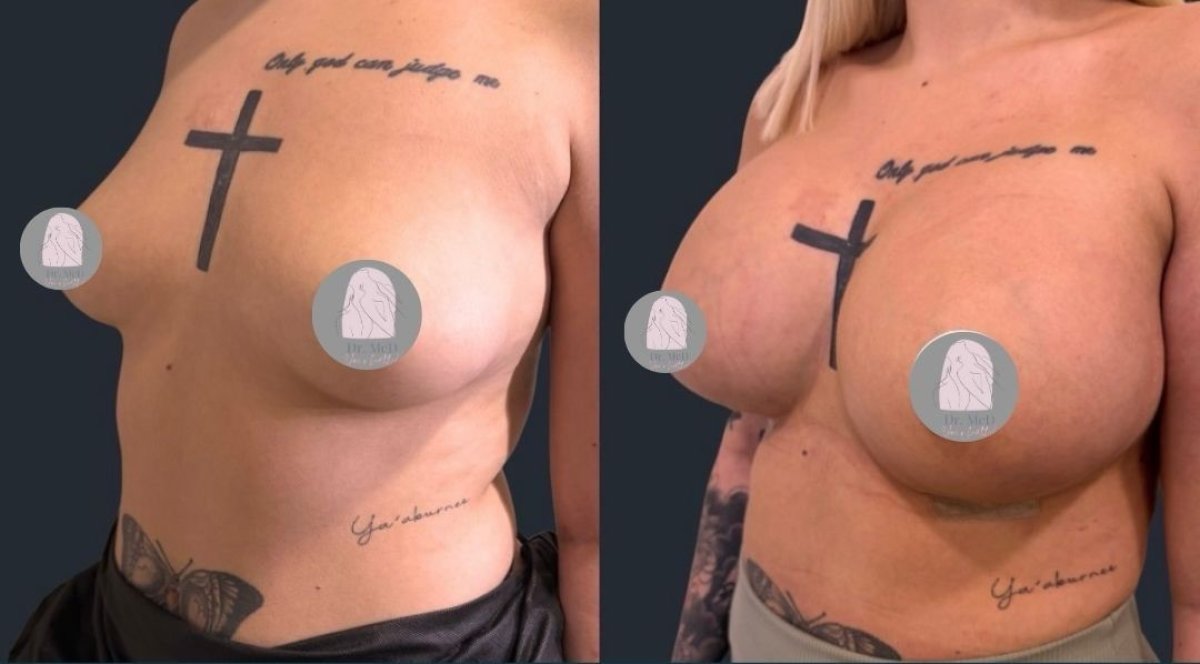 Before and after breast lift with round implants at Dr. MED – enhanced breast shape result
