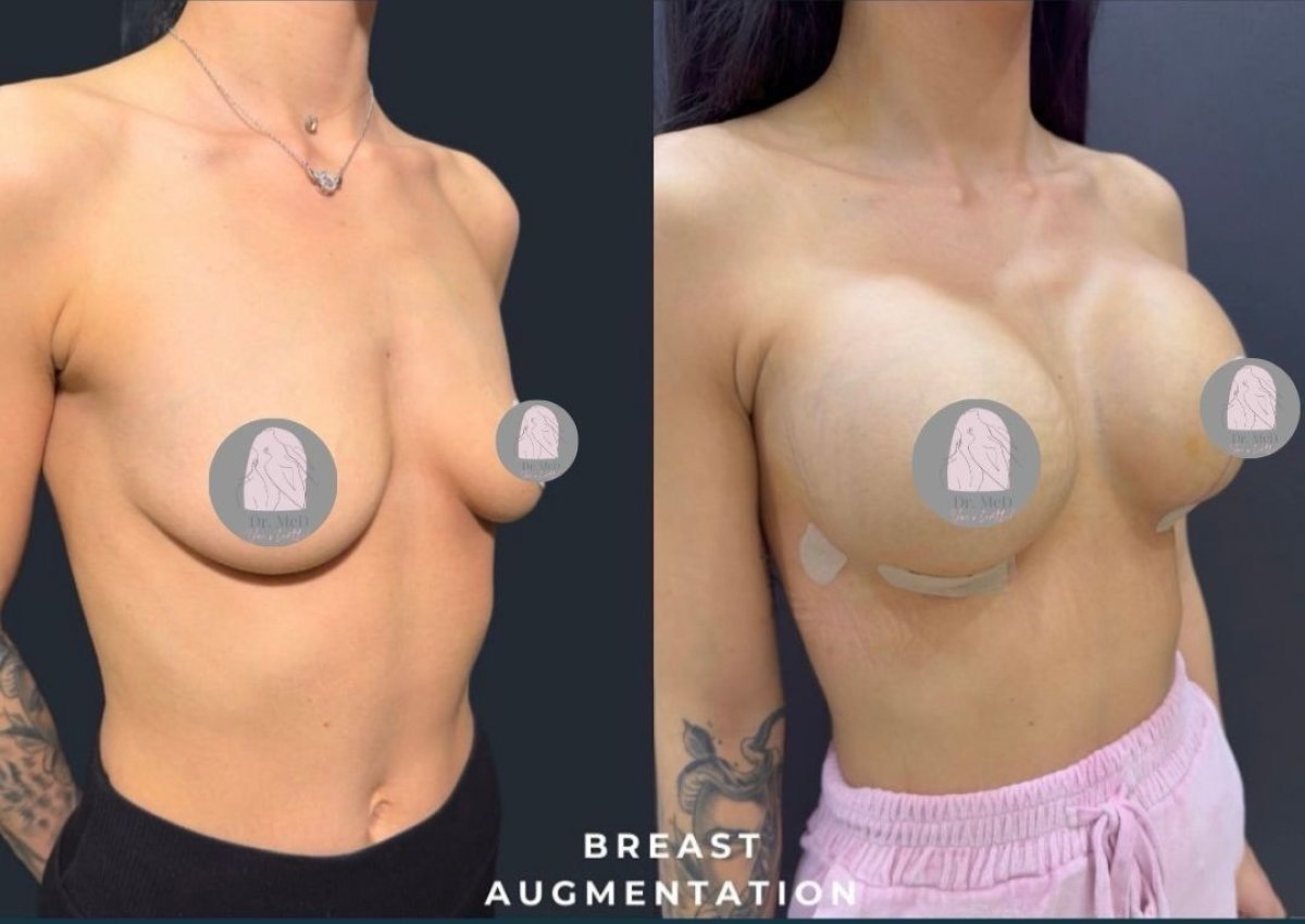 قبل وبعد رفع الثدي مع حشوات دائرية في Dr. MED – تحسين شكل الثدي