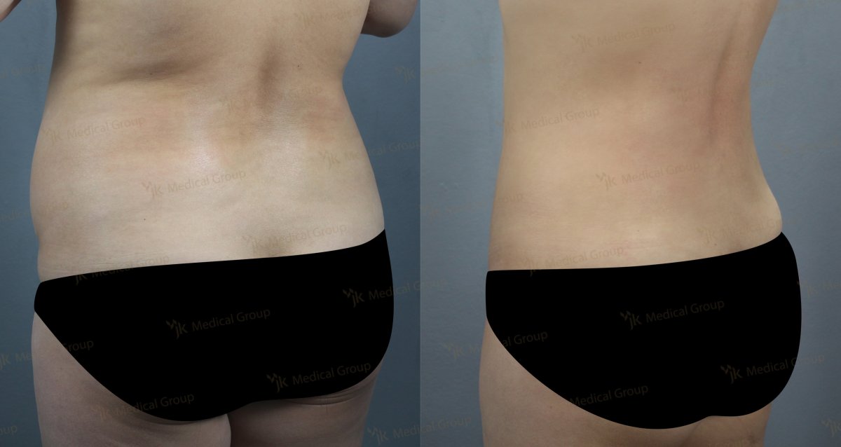 Результаты липосакции до и после в JK Plastic Surgery Center, улучшенный контур талии