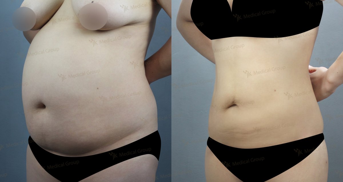 Résultats avant et après liposuccion au JK Plastic Surgery Center, remodelage abdominal visible