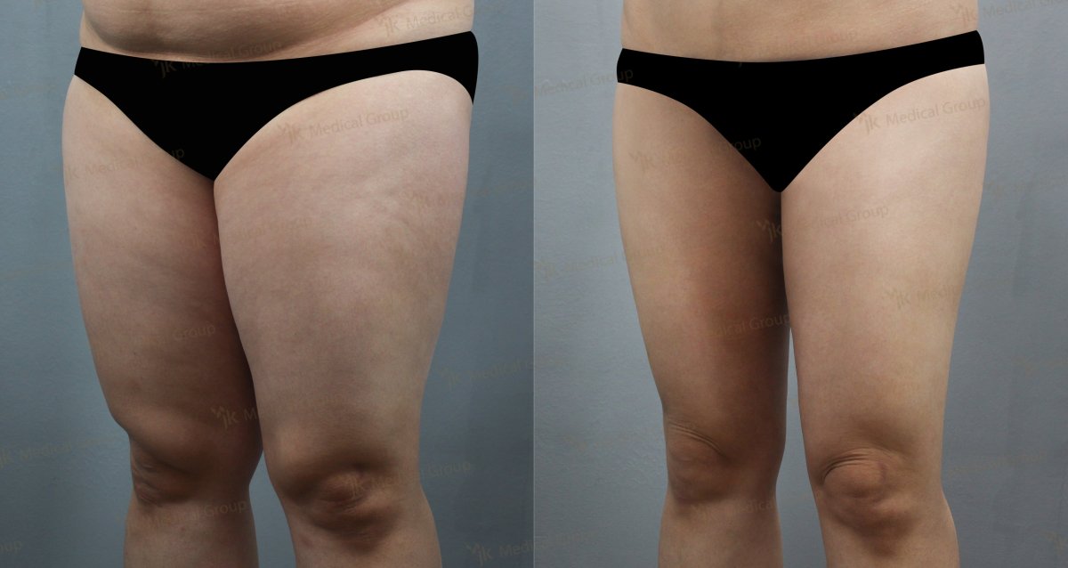 Resultados de liposucción antes y después en JK Plastic Surgery Center, mejora de muslos