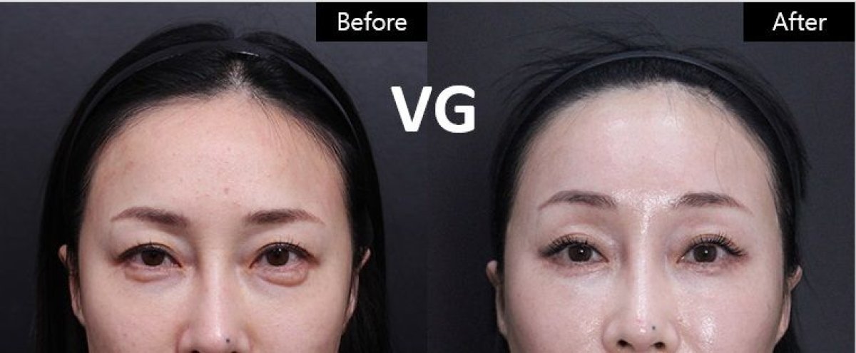 نتائج قبل وبعد جراحة الجفن المتدلي في VG Plastic Surgery، مظهر عين محسّن
