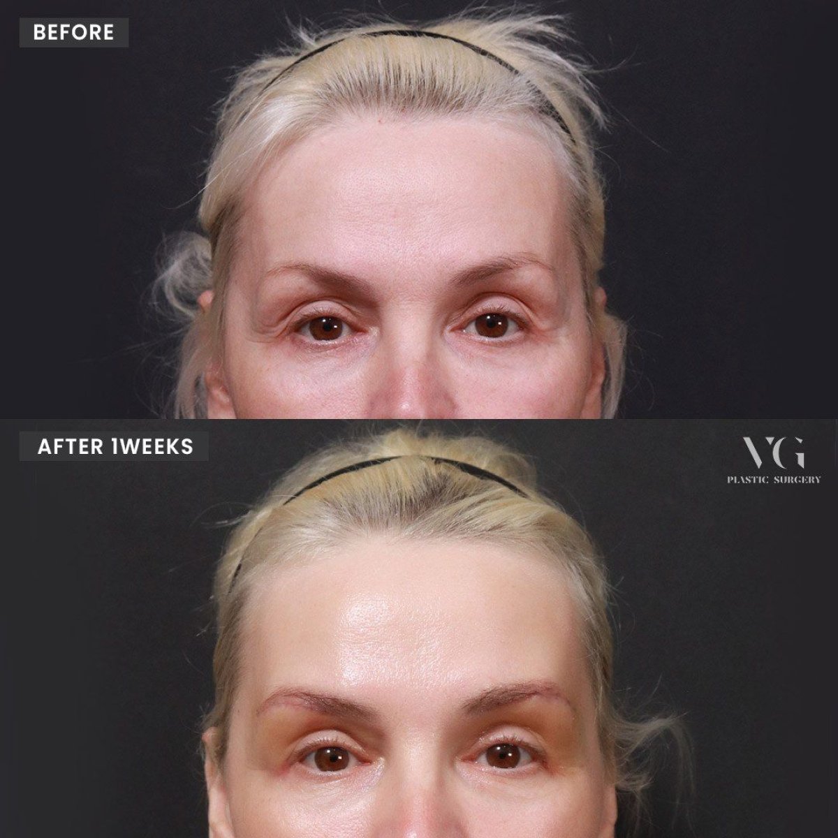 Efekty przed i po operacji opadających powiek w VG Plastic Surgery, poprawa wyglądu oczu