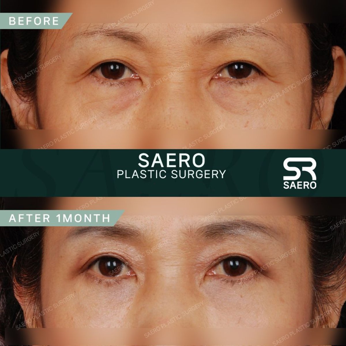 Upper eyelid surgery before and after results at SAERO Plastic Surgery, improved eye appearance