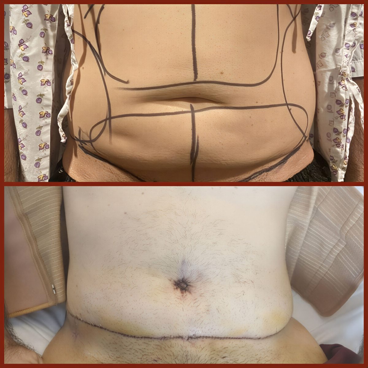 Resultados antes y después de abdominoplastia y liposucción en DGB Clinic, contorno mejorado