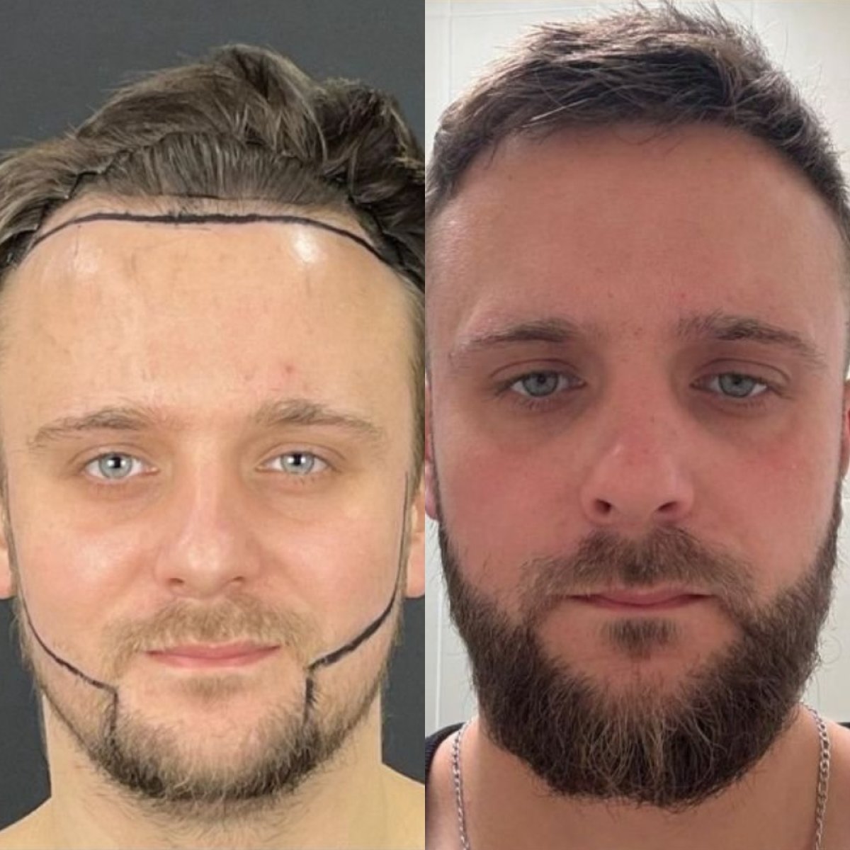 Résultats avant et après greffe de barbe à Adem and Havva Medical Center, barbe plus dense