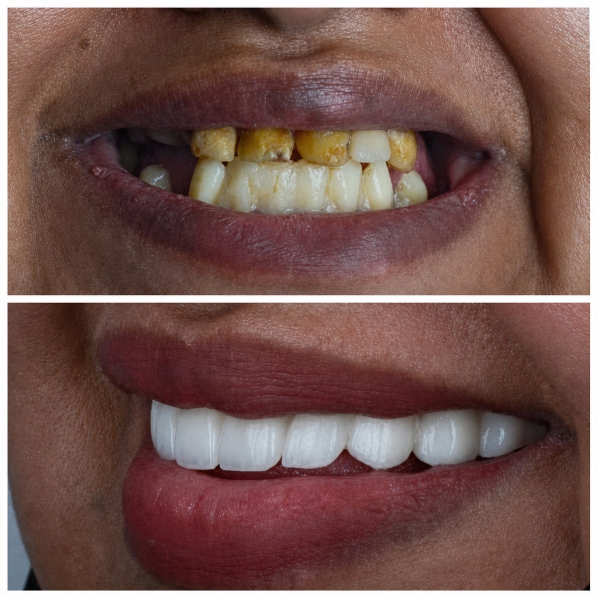 Before and after dental implant results at Omara Dental Centers – restored white smile