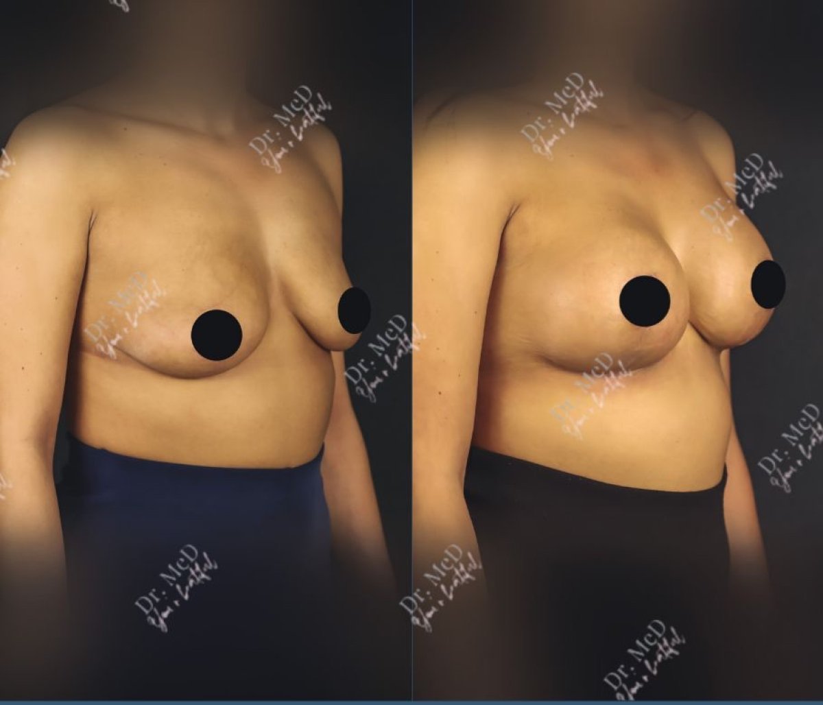 Resultados de lifting de senos antes y después en Dr. MED, mejora de forma y contorno