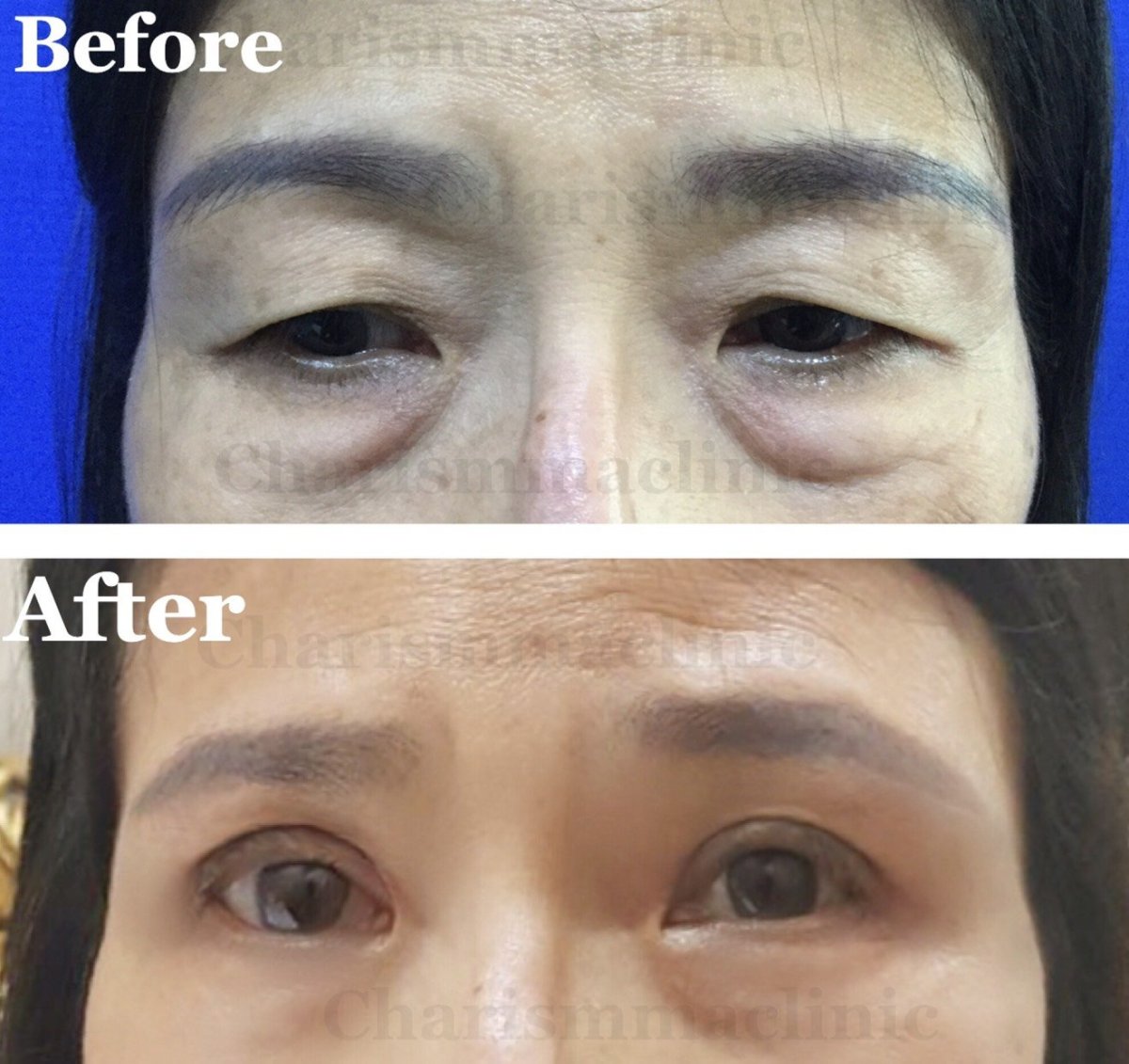 Resultados de blefaroplastia antes y después en Charismma Clinic, corrección de párpados