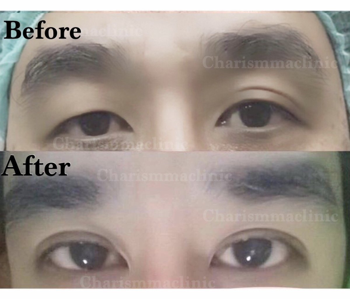 Resultados de blefaroplastia antes y después en Charismma Clinic, corrección de párpados
