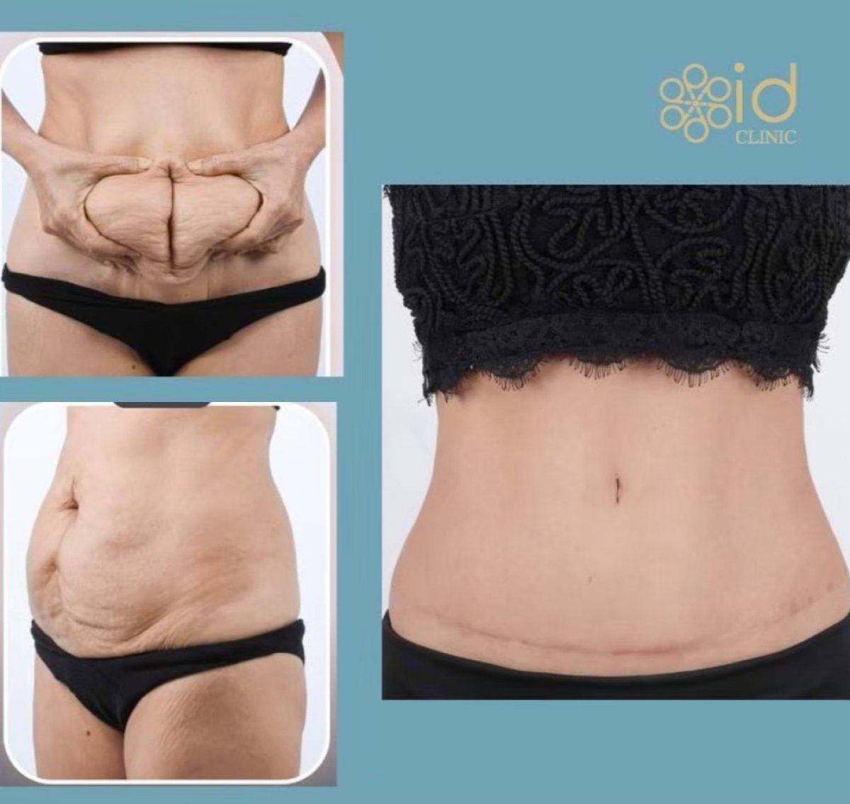 Before and after Vaser 3 areas plus tummy tuck results at ID Clinic Bangkok, flatter abdomen
