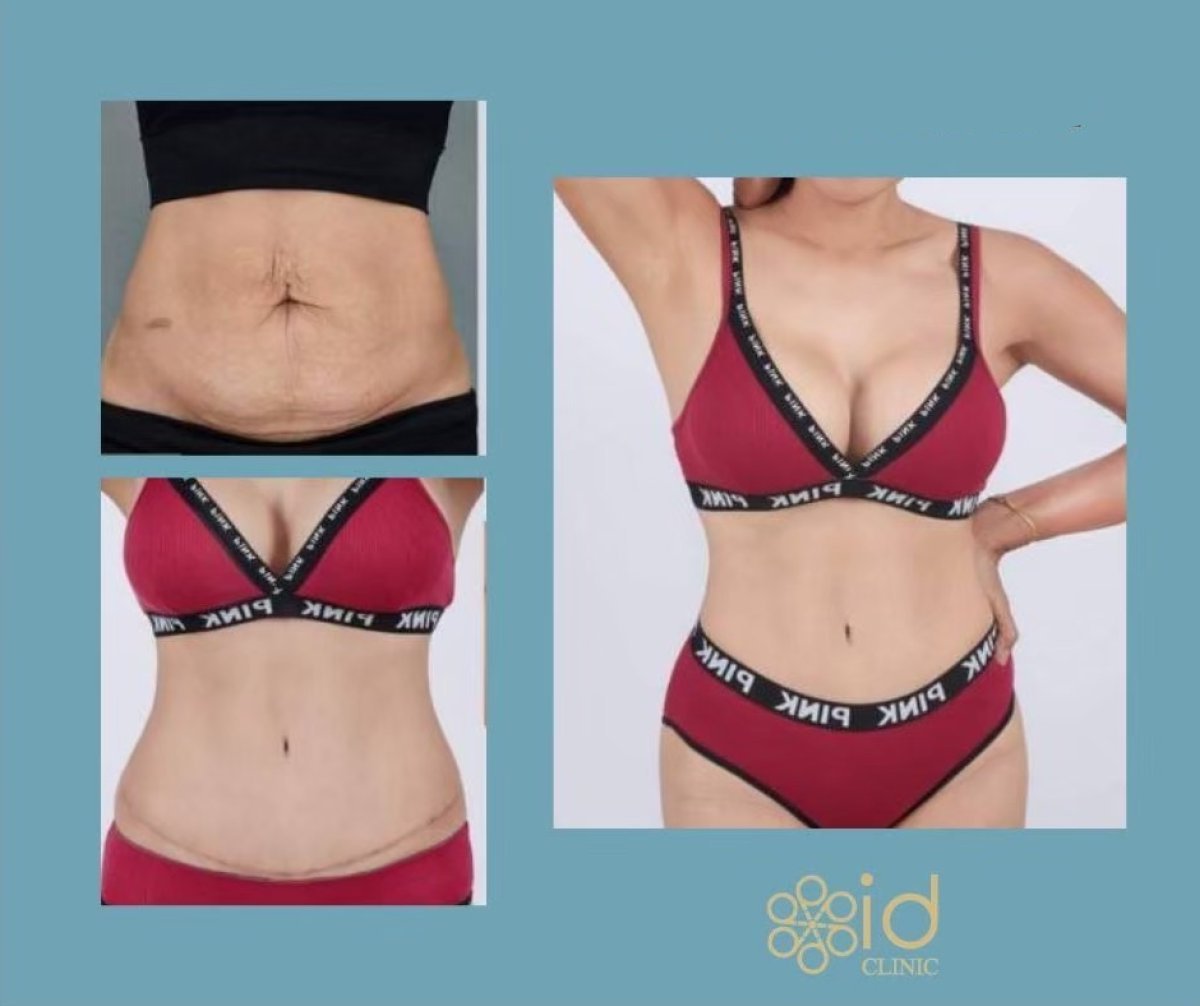 Avant et après mommy makeover à ID Clinic Bangkok, résultat visible sur l’abdomen