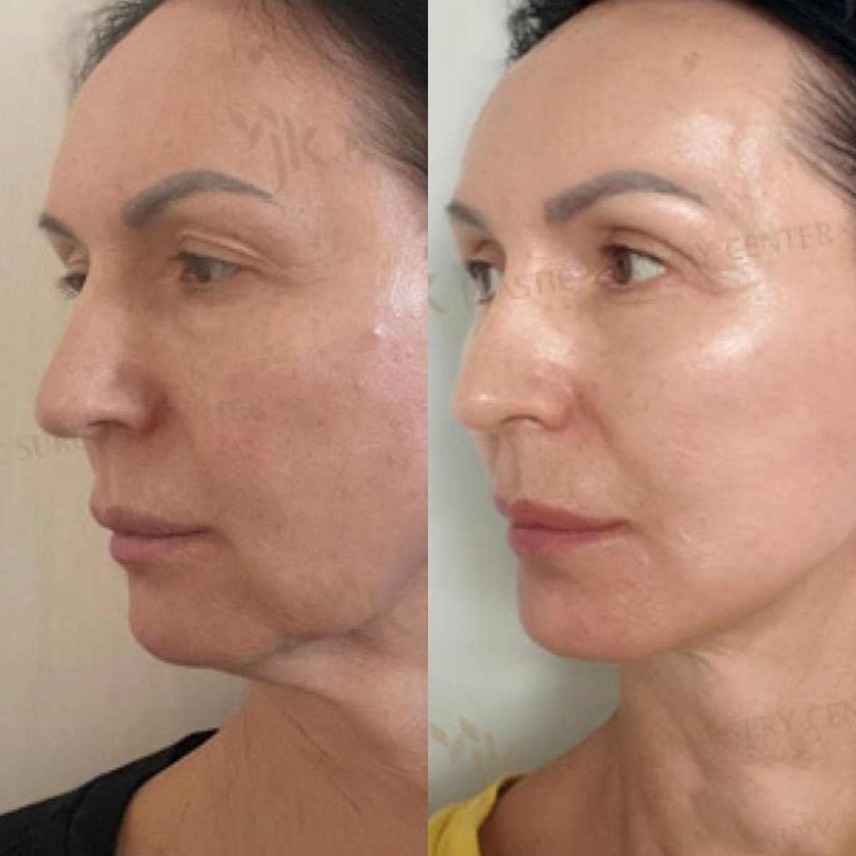 نتائج قبل وبعد شد الوجه العميق في JK Plastic Surgery Center، تجديد شباب الوجه