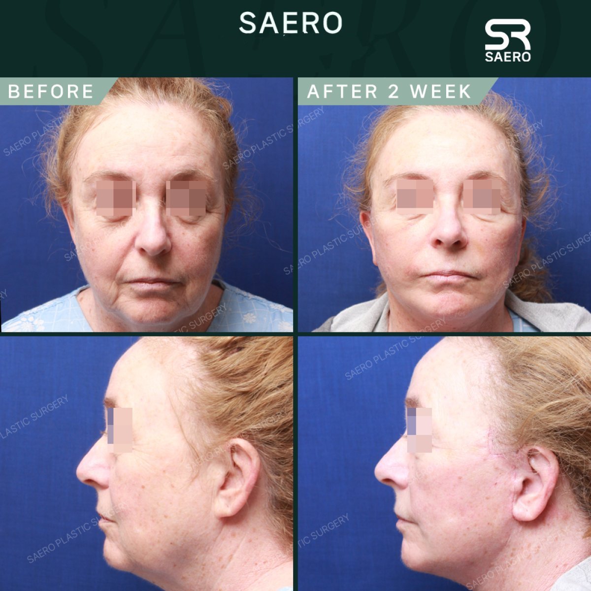 نتائج شد الوجه العميق قبل وبعد في SAERO Plastic Surgery، تجديد شباب الوجه