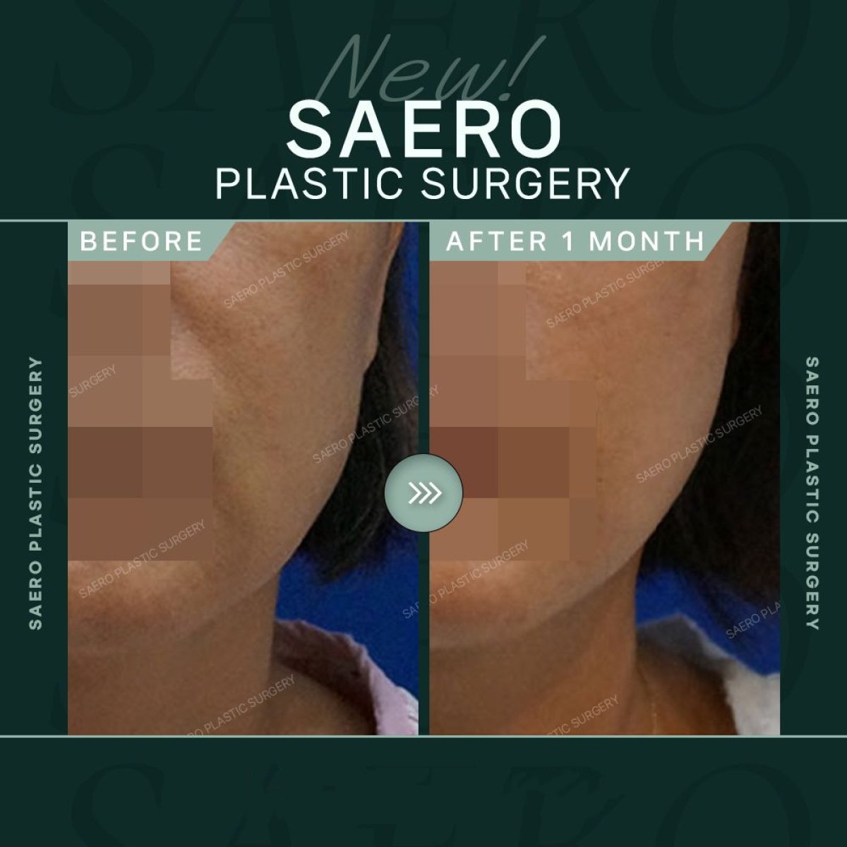 نتائج شد الوجه العميق قبل وبعد في SAERO Plastic Surgery، رفع واضح للفك