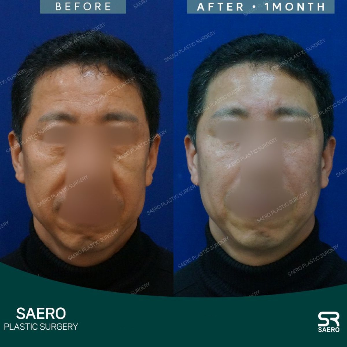 نتائج شد الوجه العميق قبل وبعد في SAERO Plastic Surgery، رفع واضح للوجه