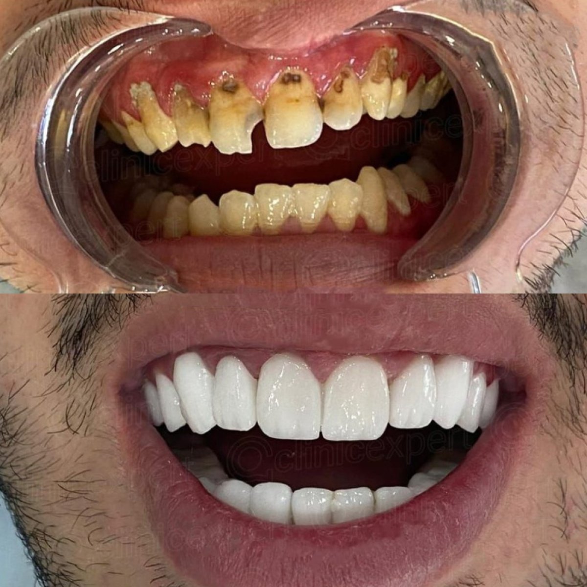 نتائج قبل وبعد زراعة الأسنان في CE International Hospital – ابتسامة طبيعية مستعادة