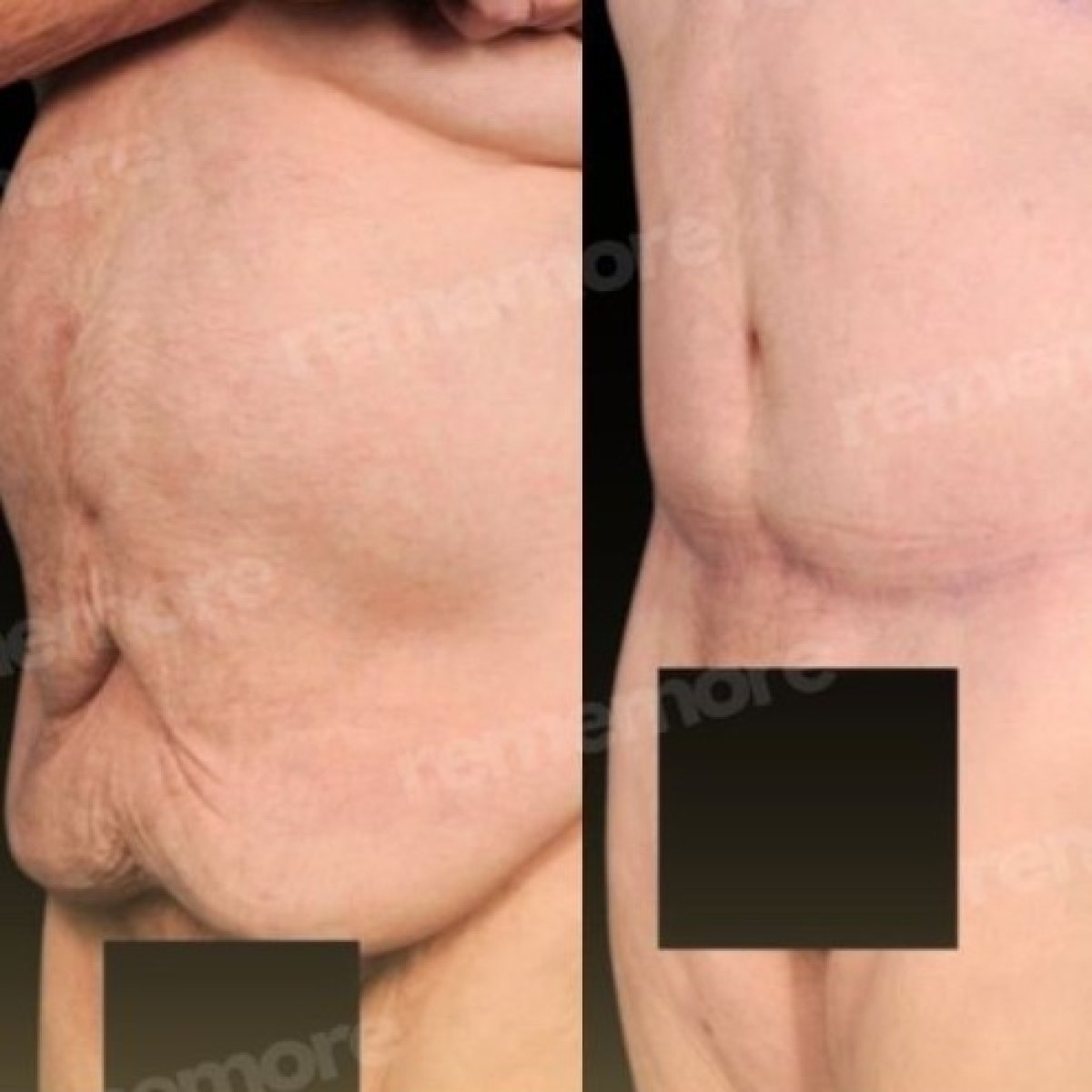 Before and after tummy tuck results at Memorial Göztepe Hospital, improved abdominal contour