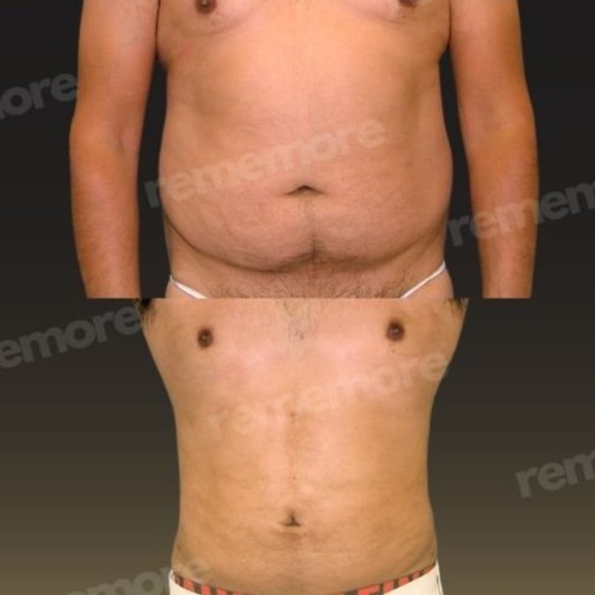 Before and after tummy tuck results at Memorial Göztepe Hospital, improved abdominal contour