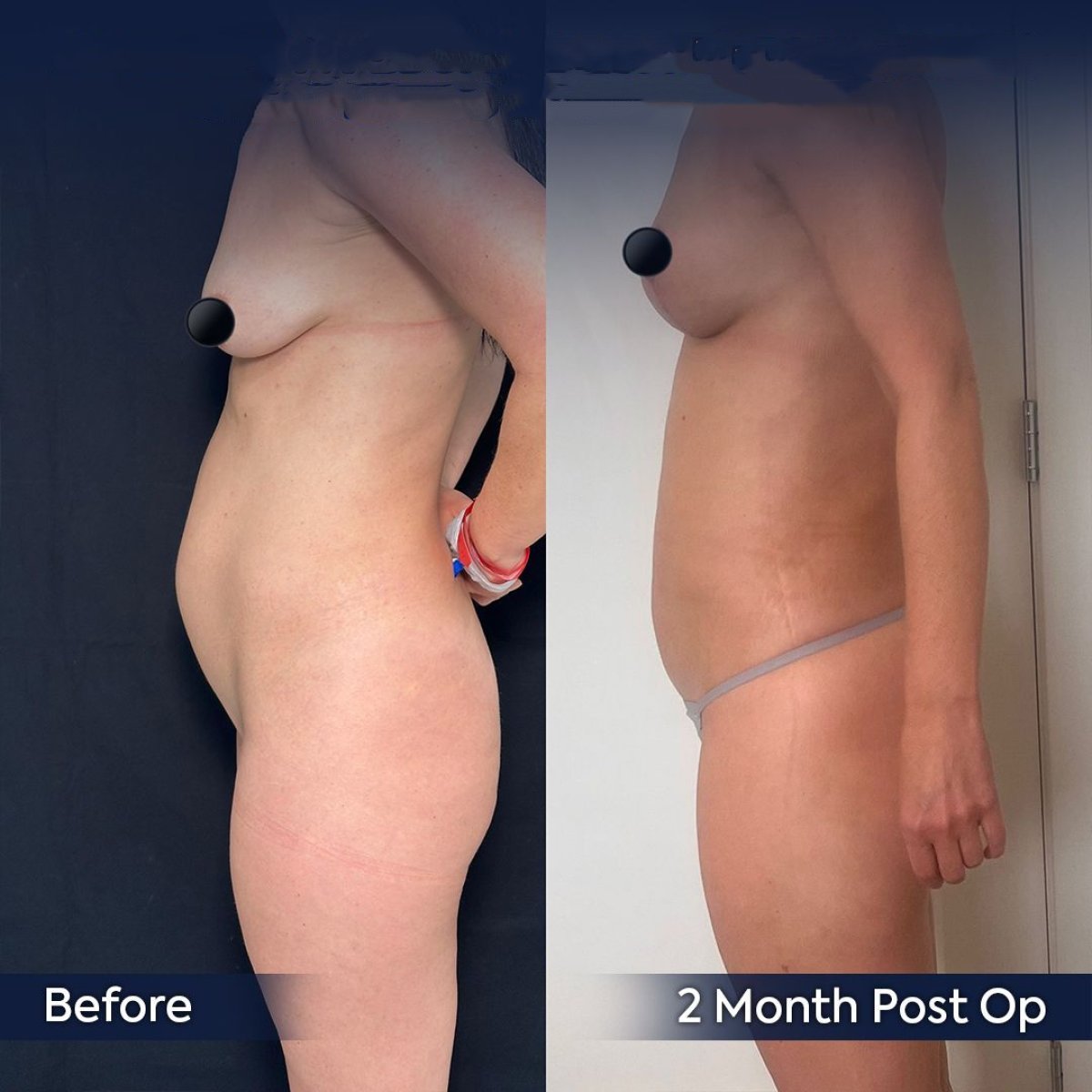 نتائج قبل وبعد شفط الدهون فايزر في عيادة د. صفا مناف، تحسين شكل الجسم