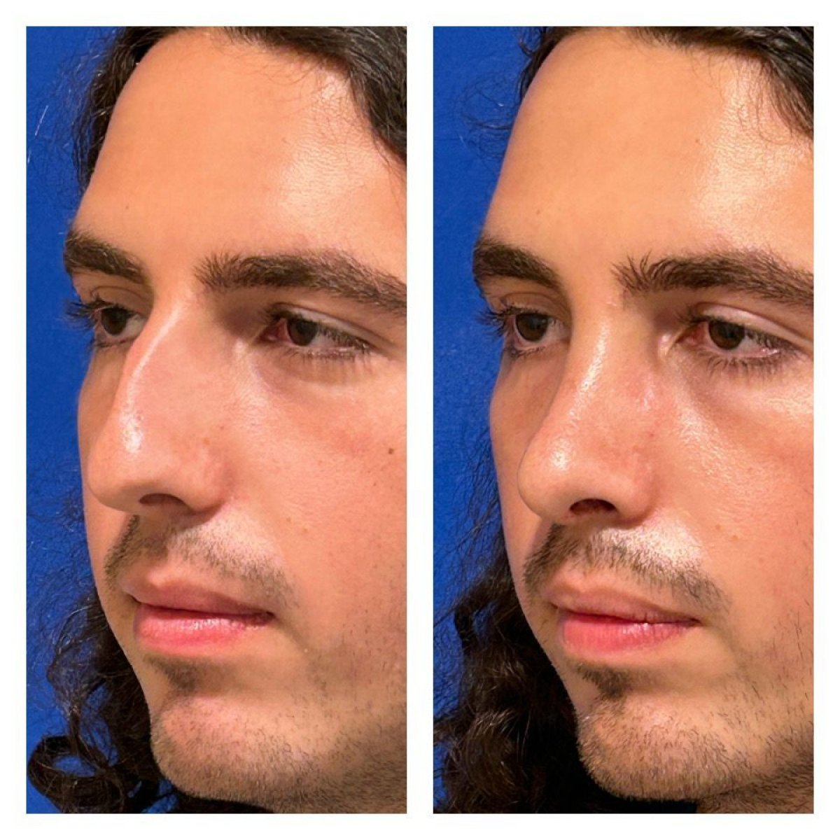 Resultados de rinoplastia étnica antes y después en Memorial Şişli Hospital, remodelación nasal