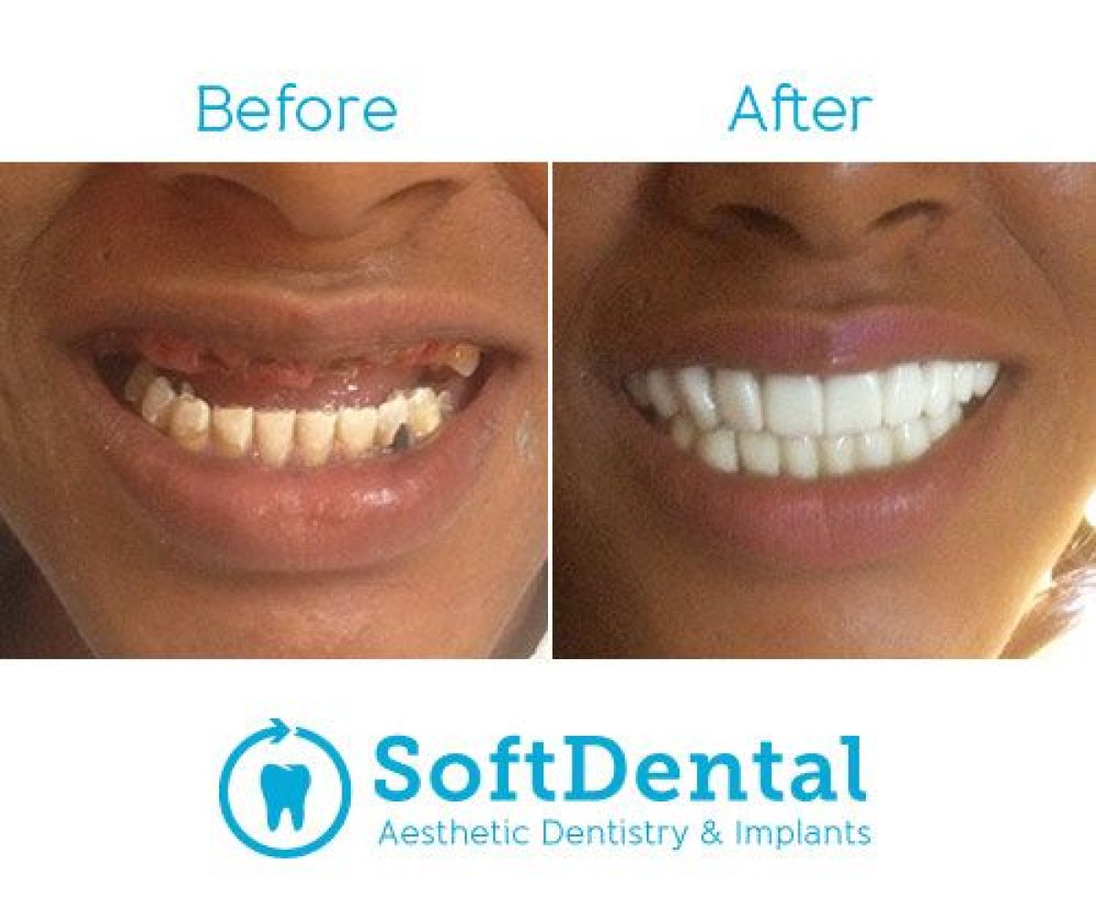 Результат до и после полного протеза на имплантах из циркония в SoftDentalCare Clinic